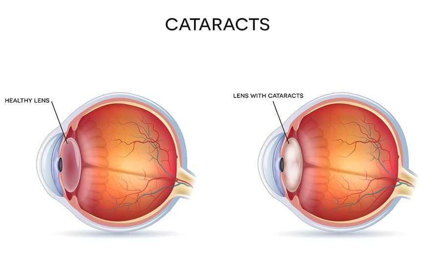 What is a Cataract? How does it affect Vision?