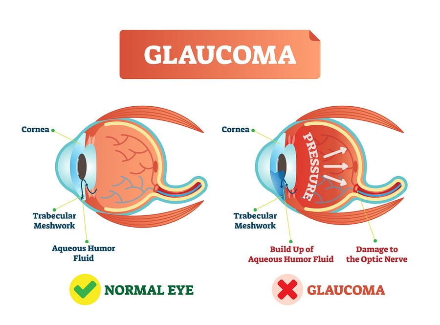 Understanding Glaucoma  –  Why You Should Be Concerned
