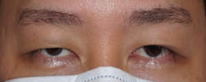 Eyelid Ptosis Correction Surgery Singapore