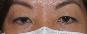 Ptosis Eye Surgery