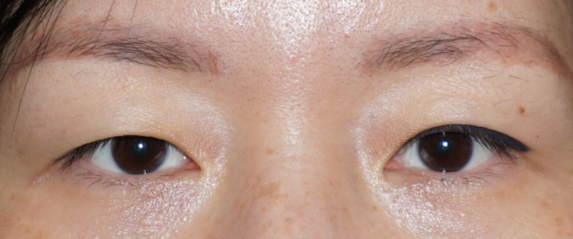 What To Expect When You Undergo Double Eyelid Surgery