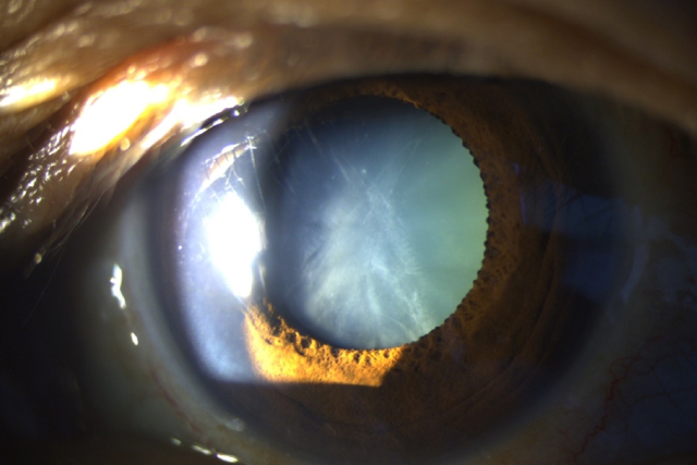 Debunking 5 Of the Most Common Myths About Cataracts
