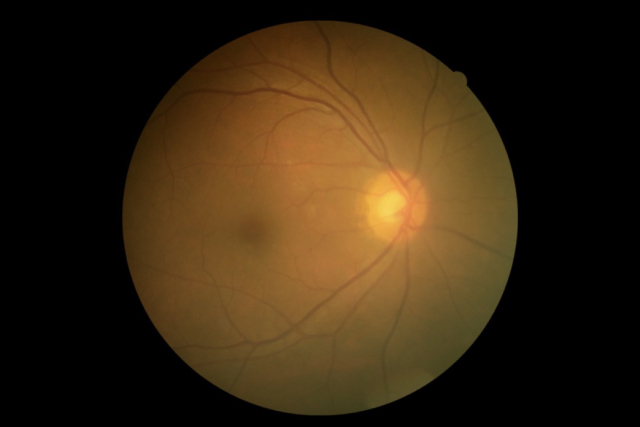 Hazy view of retina due to presence of cataract