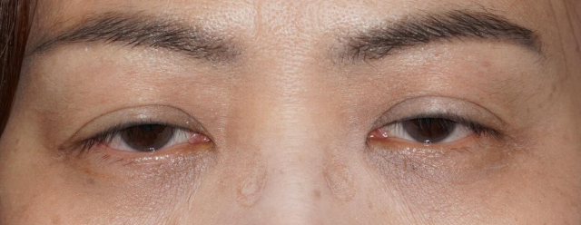 Ptosis: 5 Signs You Are A Good Candidate For Surgery